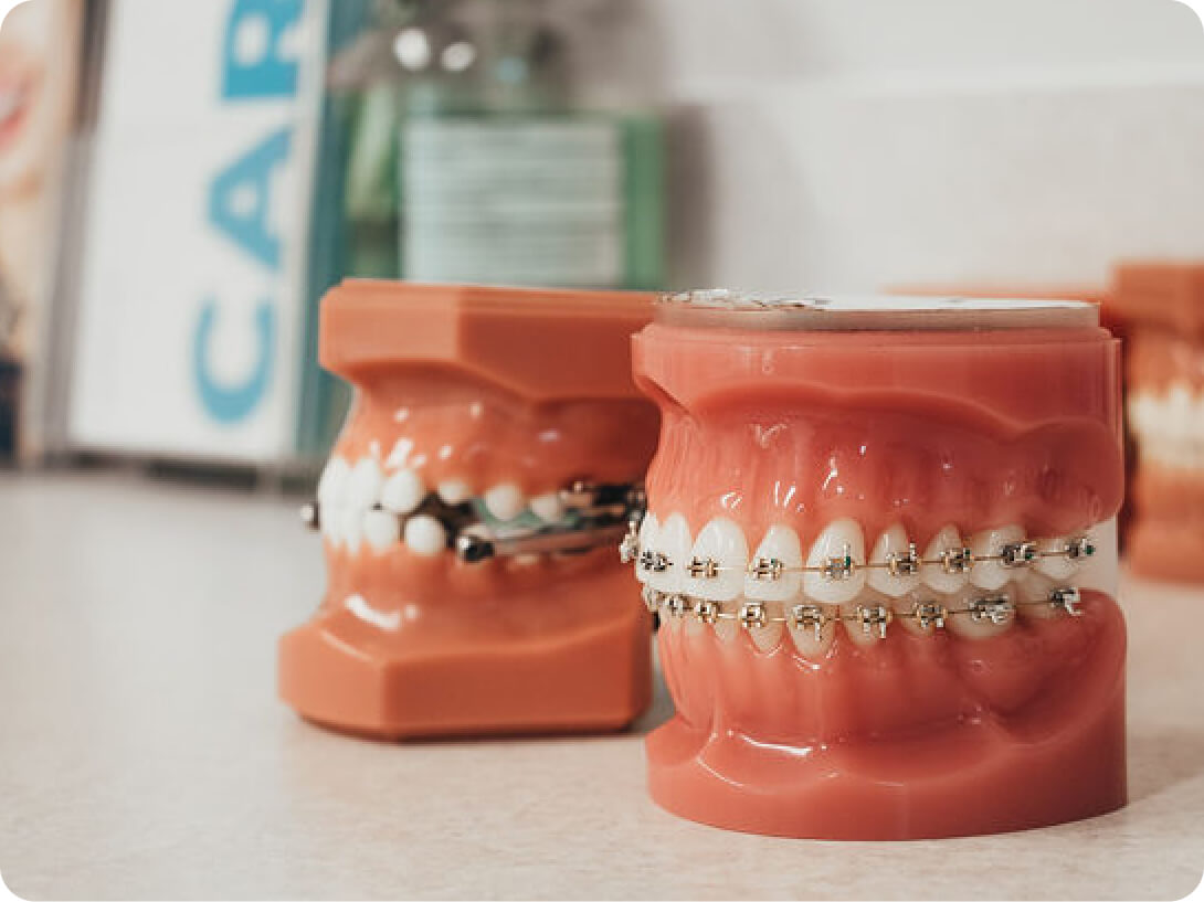 How Long Will My Teeth Feel Loose with Braces?