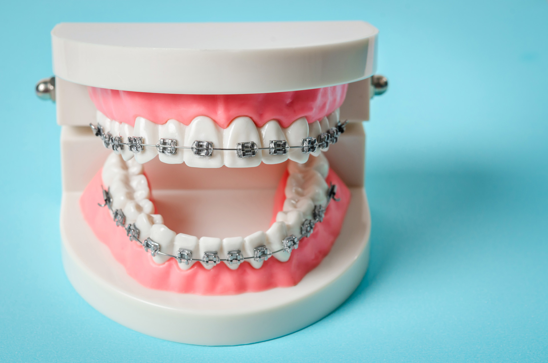 orthodontics and dental anxiety
