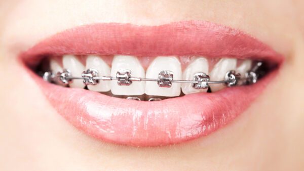 types of orthodontic treatment