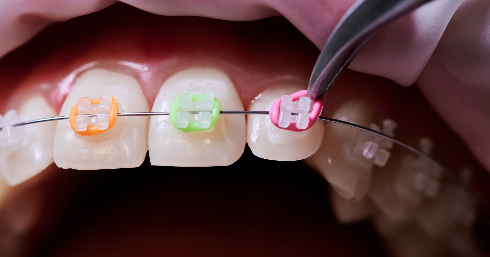 Braces Colors Selector