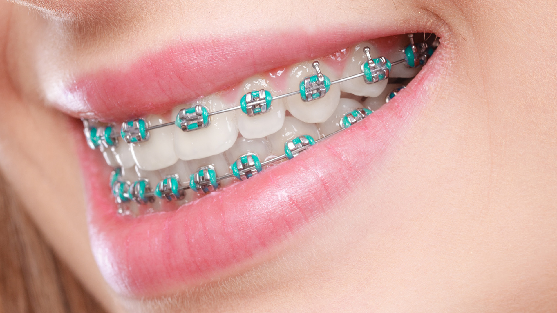 How Much Are Braces in Florida? A Comprehensive Guide
