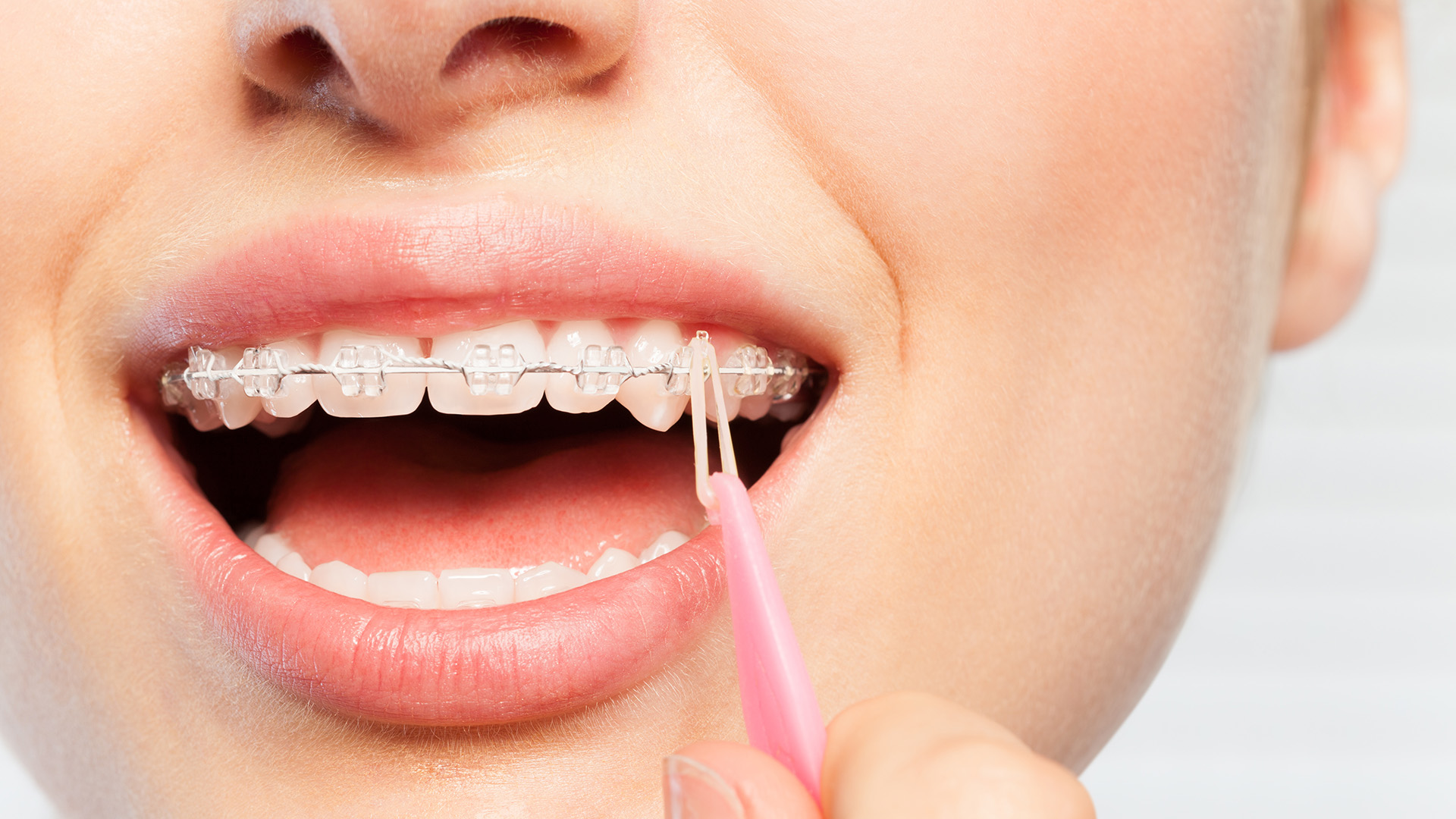 how elastics move your bite