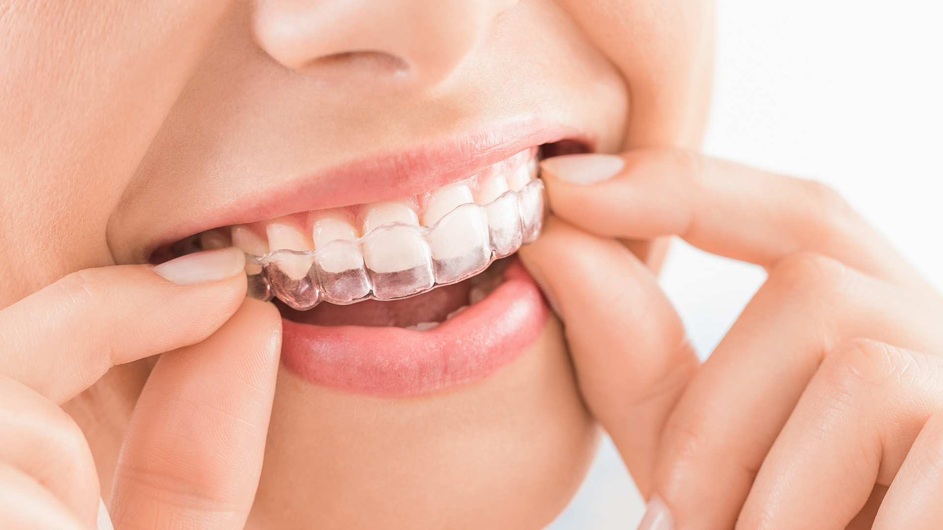 Can You Eat with Invisalign Trays In?