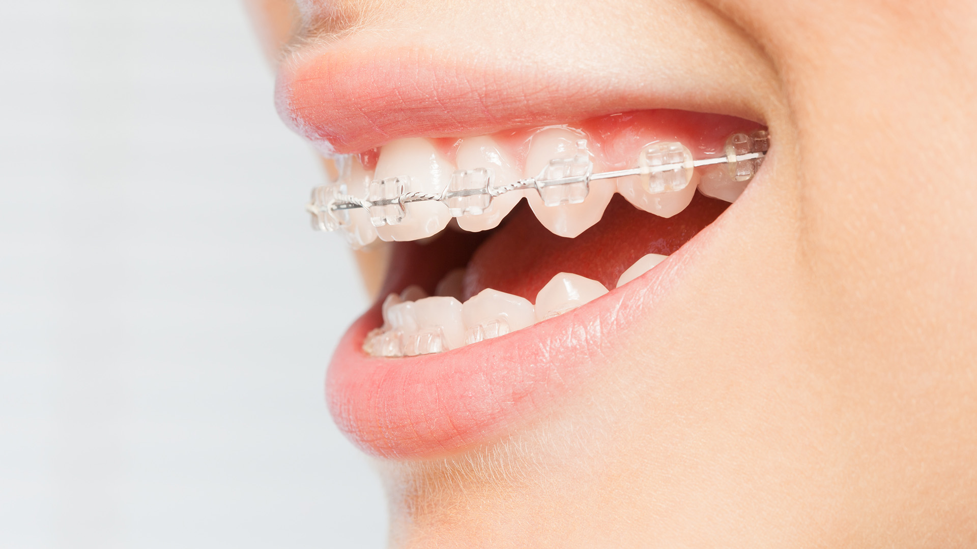 Ceramic Braces vs Invisalign