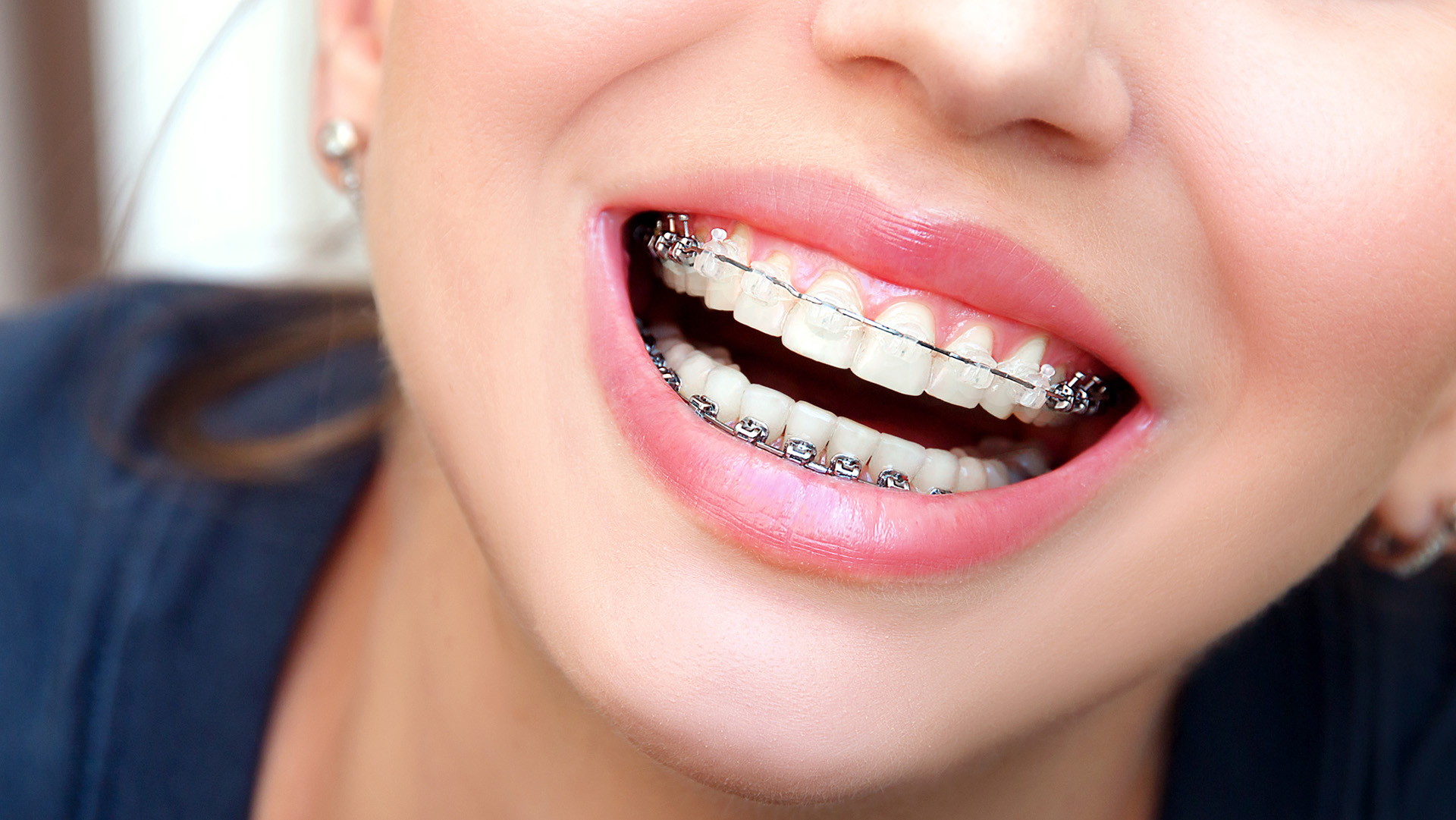clear ceramic braces