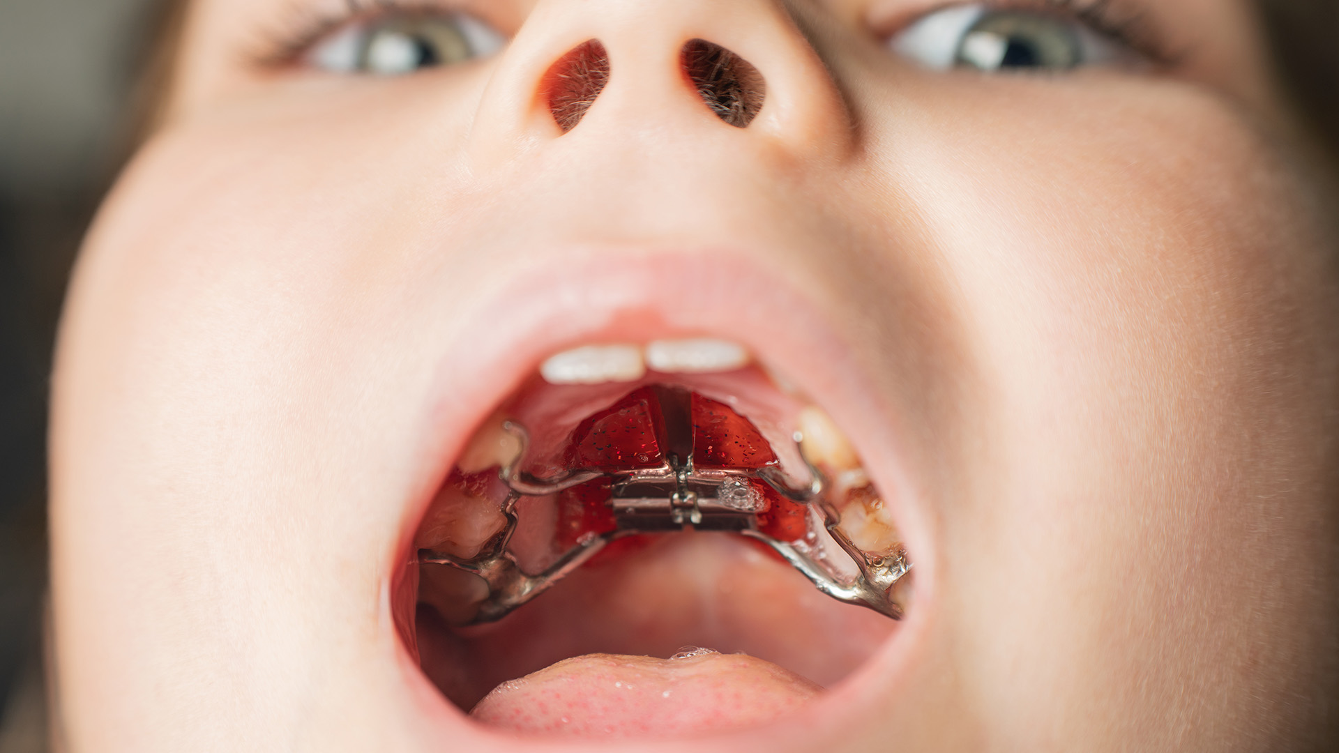What Is a Palatal Expander?