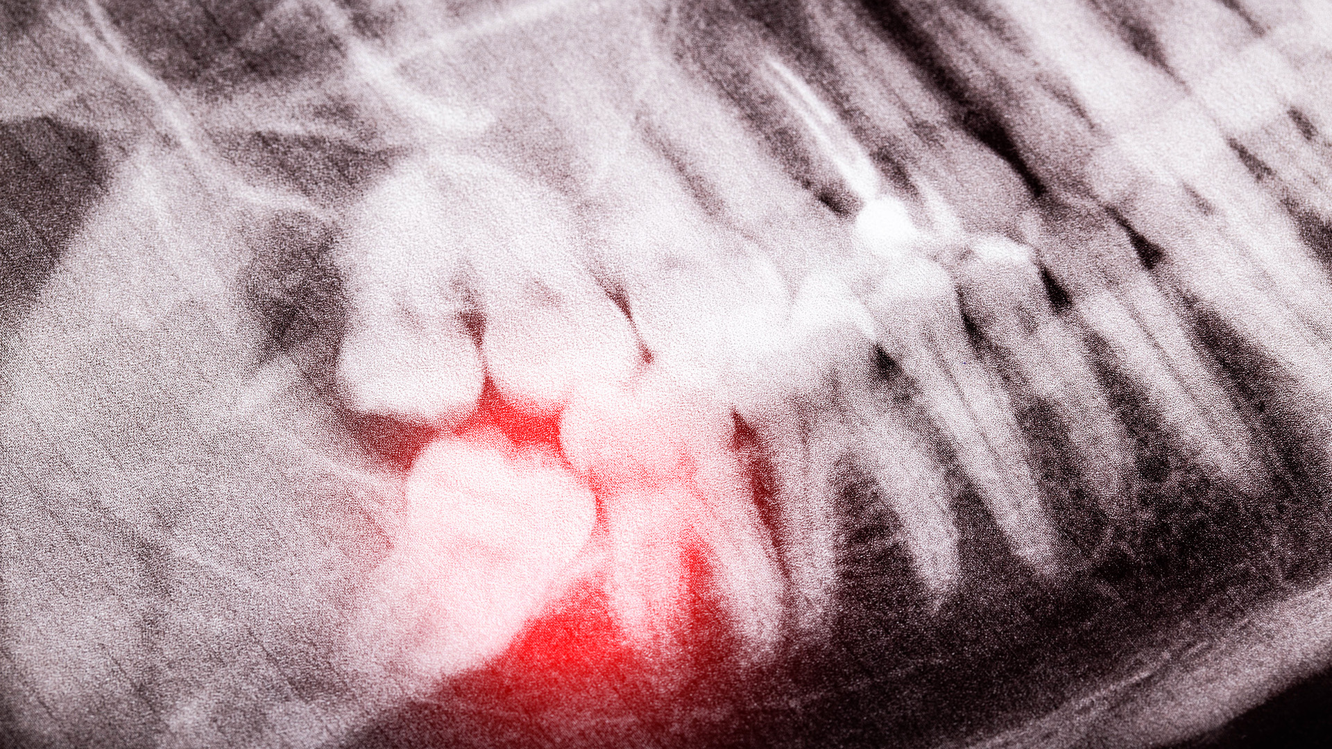 impacted wisdom teeth need to be removed for braces
