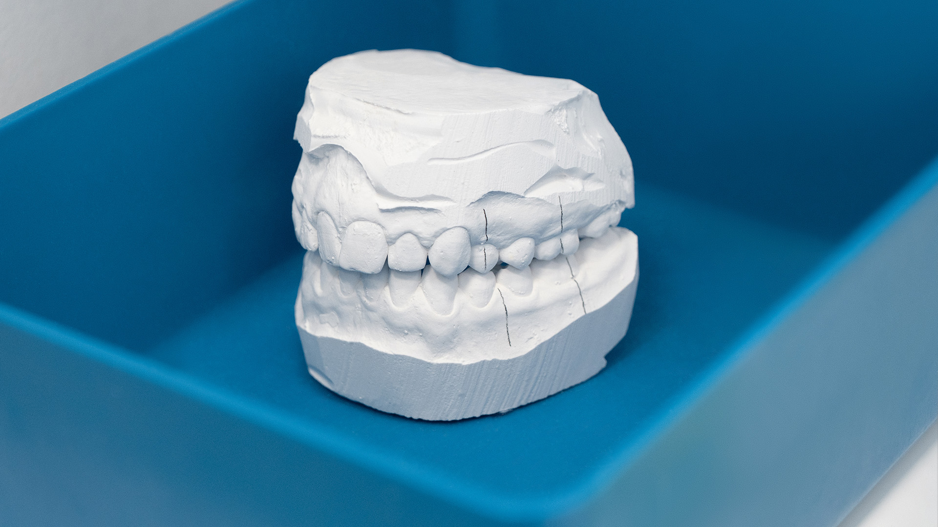 Can Braces Fix Jaw Alignment in Adults?
