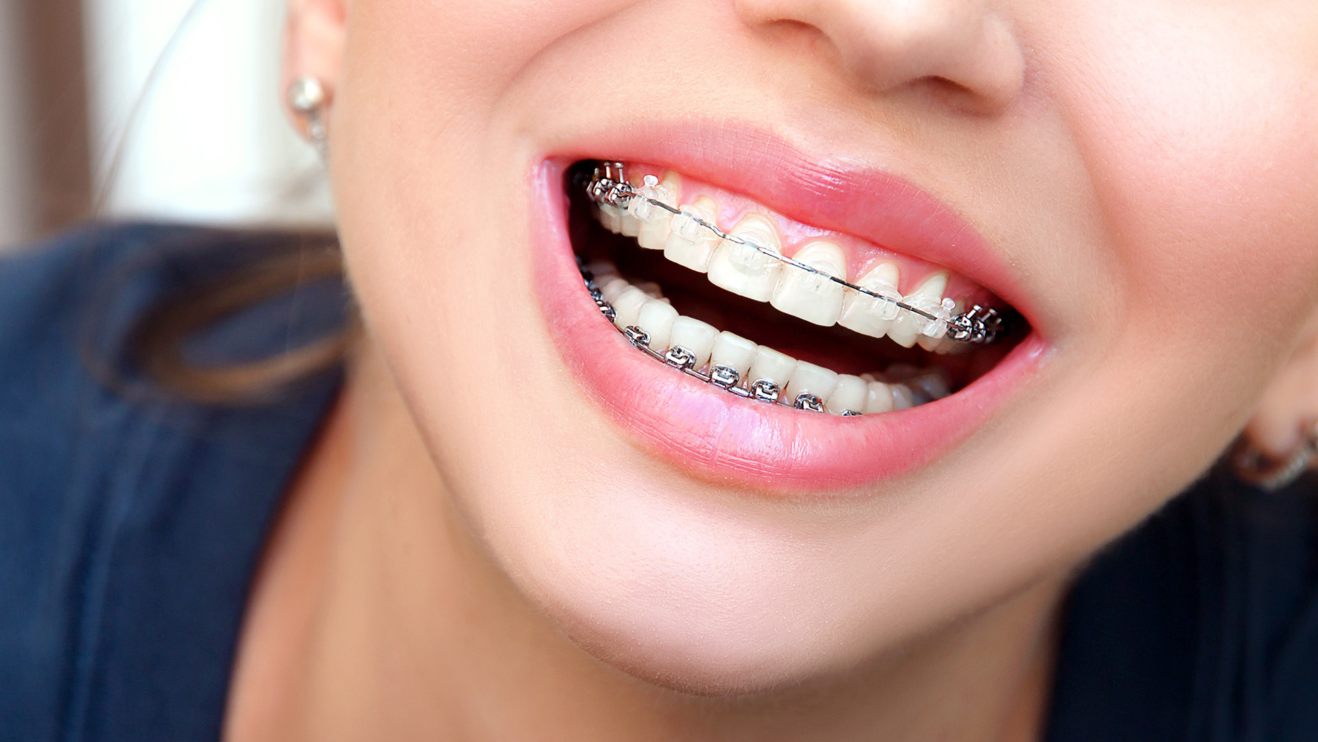 Will Braces Make My Face More Symmetrical?